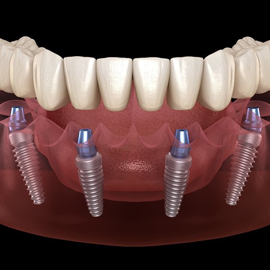 Front-view illustration of All-on-4 dental implants in lower dental arch