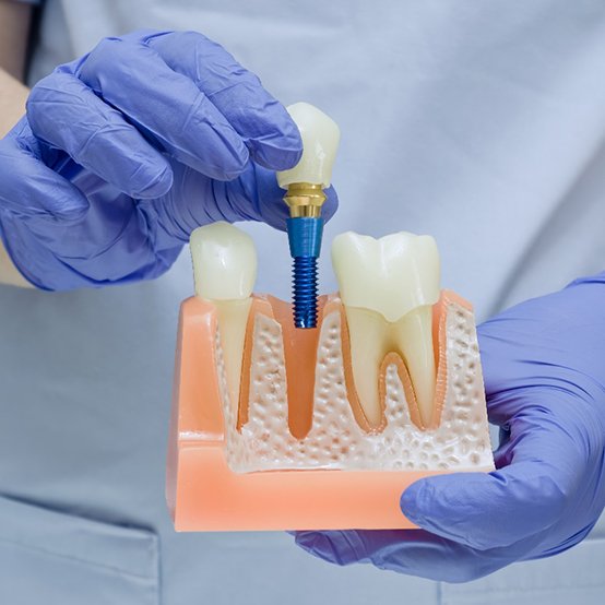 Gloved hands holding model of traditional dental implant