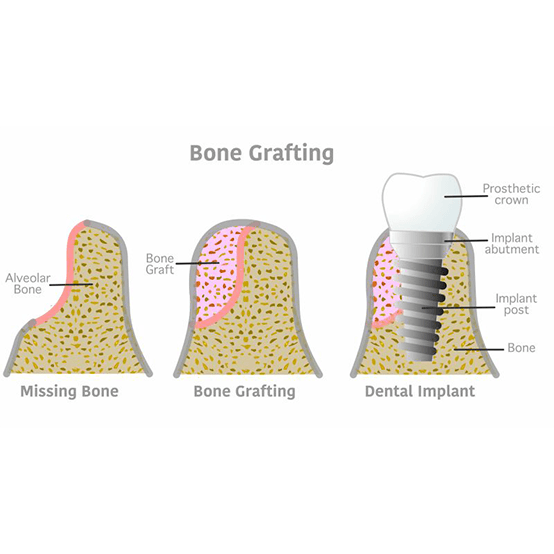 Illustration of the bone grafting process