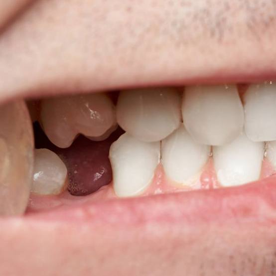 Close-up of person’s mouth with a missing tooth