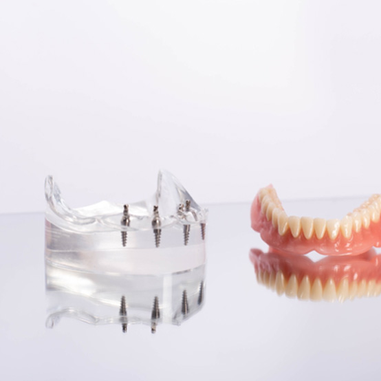 Implant dentures next to model of jawbone