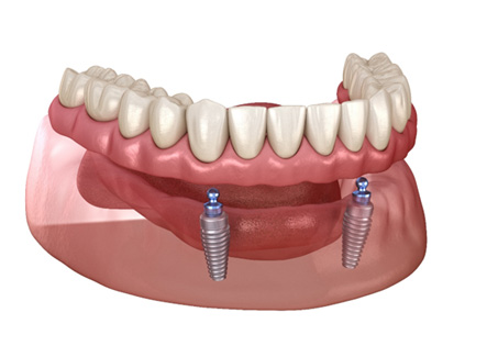 Illustration of removable implant denture against white background