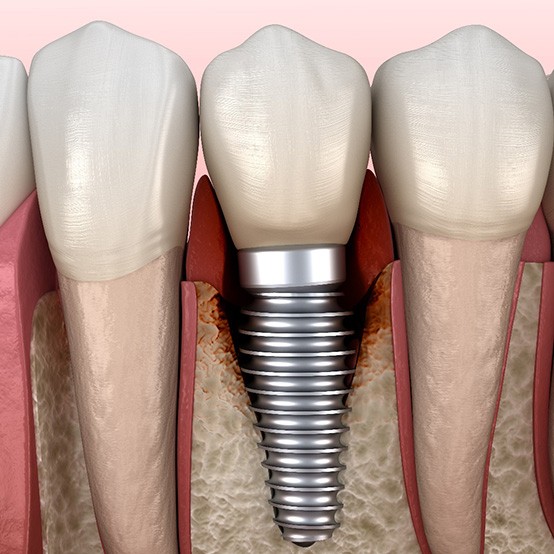 Illustration showing infection around a dental implant