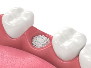 Illustration of grafted bone granules in tooth socket